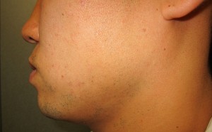 ヒゲ脱毛　川口　さいたま