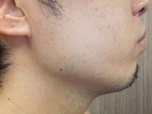 ヒゲ脱毛
